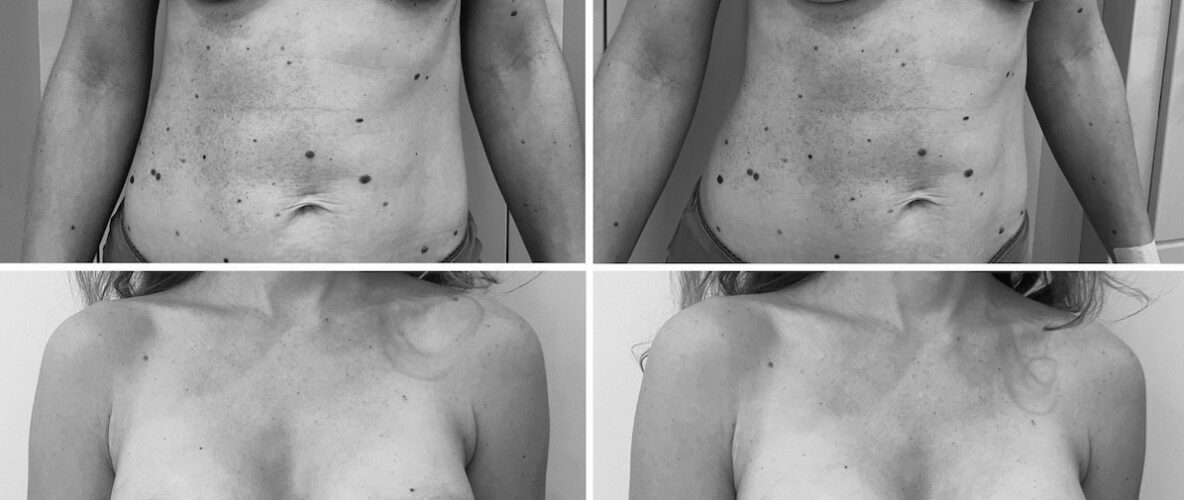 Megereszkedett mellek műtétje felvarrás nélkül