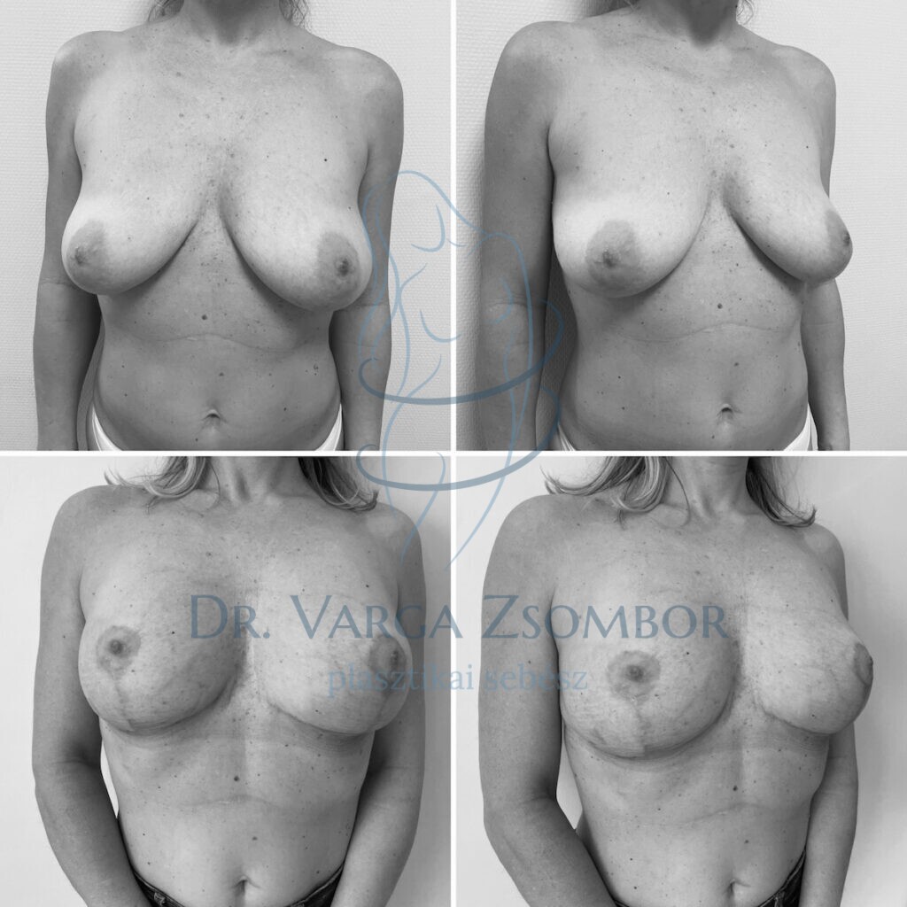 Mellfelvarrás előtt és után