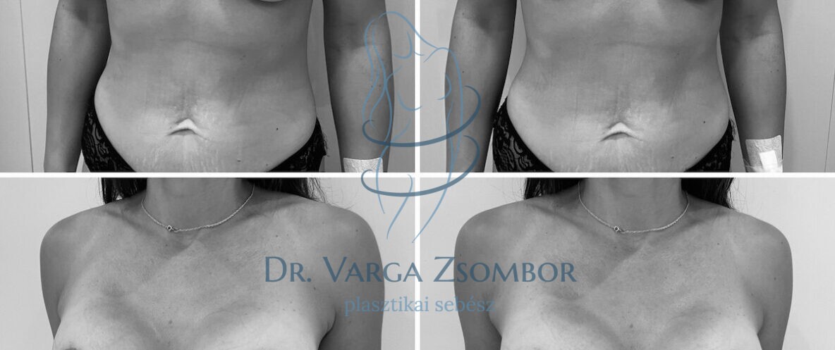 Mellfelvarrás implantátummal