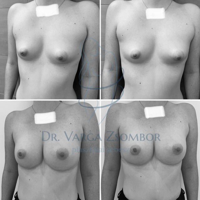 tubuláris mell, csőmell, aszimmetria