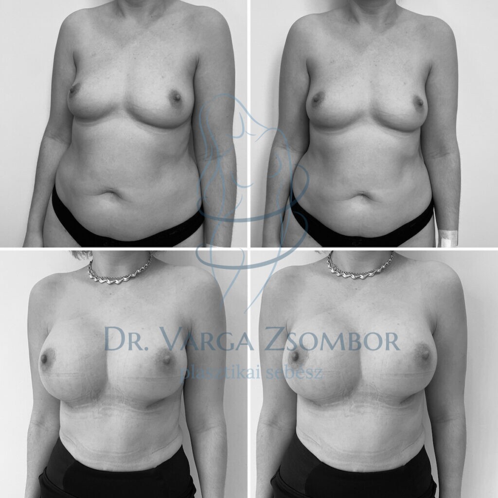 mommy makeover előtte utána kép (hasplasztika és mellplasztika)