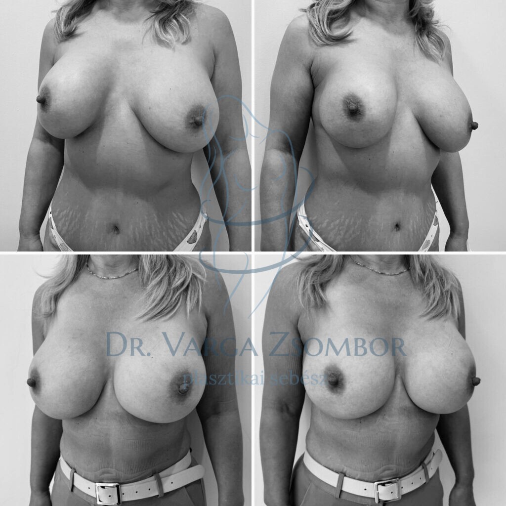 implantátumcsere tokeltávolítással